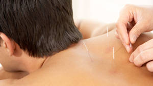 Acupuncturist Alternative Medicine Wallpaper